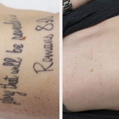 Example Laser Removal 6 Session