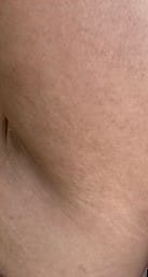 after stretch mark serum treatment