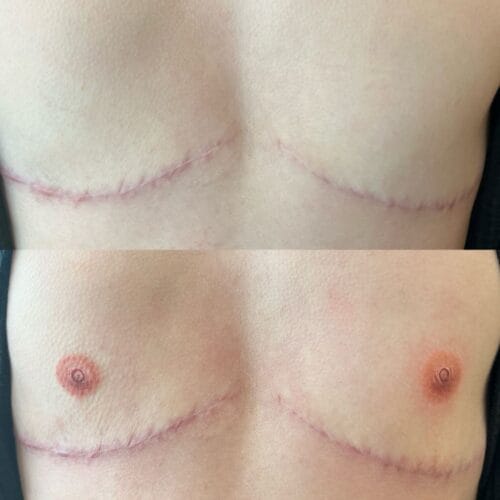 Areola Restoration in Portland at DAELA by Lina