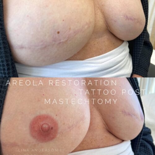 Areola Restoration in Portland at DAELA by Lina