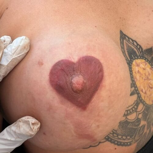 Areola Restoration in Portland at DAELA by Lina
