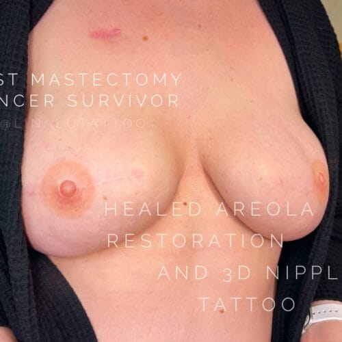 Areola Restoration in Portland at DAELA by Lina