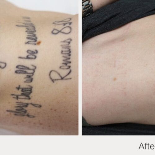 Laser Tattoo Removal in Scottsdale at DAELA