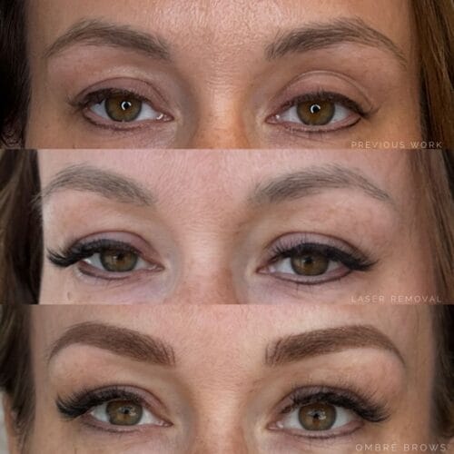 Cosmetic Laser Tattoo Removal at DAELA Portland by Bella