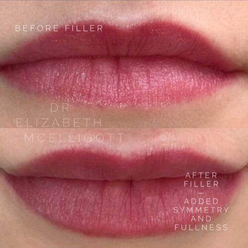 Filler and Lip Blush Tattoo at DAELA Cosmetic Tattoo Portland
