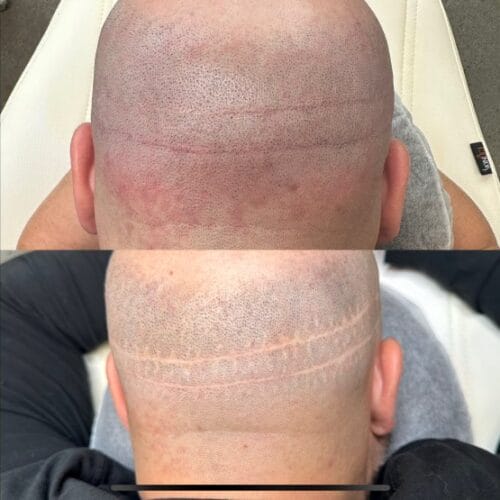 Hair Transplant Scar Cover up with SMP