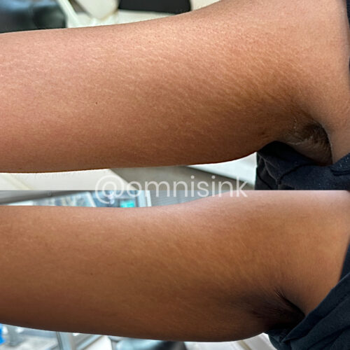 Stretch Mark Treatments Vancouver DAELA Shonna