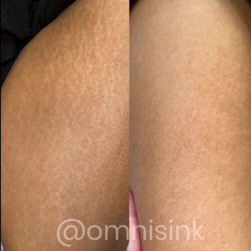 Stretch Mark Treatments Vancouver DAELA Shonna