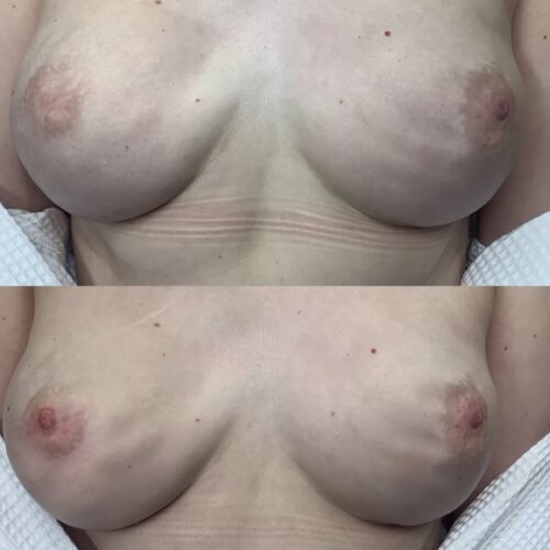 Areola Restoration Tattoo Vancouver DAELA Lina