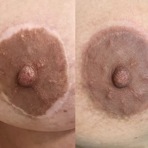 Areola Restoration Tattoo Portland DAELA Lina