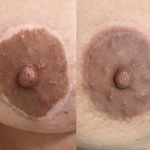 Areola Restoration Tattoo Vancouver DAELA Lina
