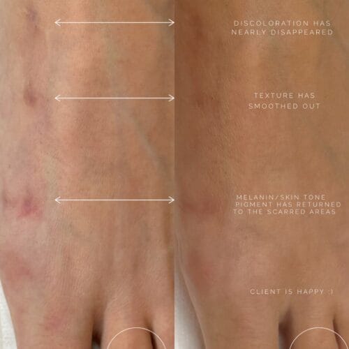 Scar Camouflage tattoo in Scottsdale at DAELA Cosmetic Tattoo