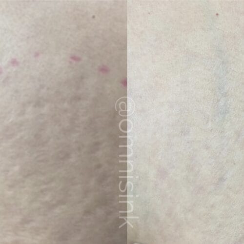 Radiation Marker Camouflage DAELA Cosmetic Tattoo Portland-Shonna