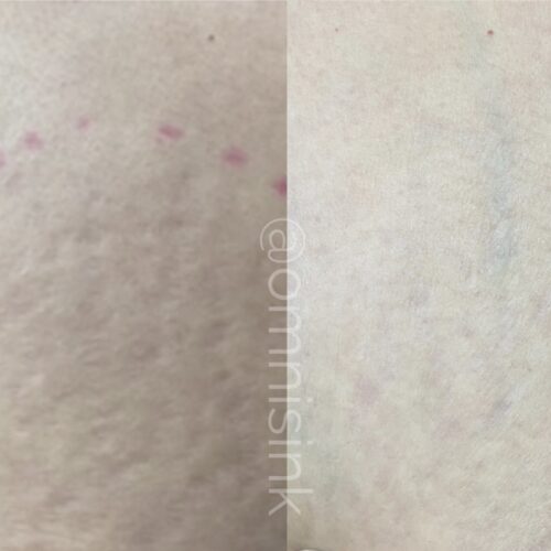 scar camo radiation markers vancouver daela shonna