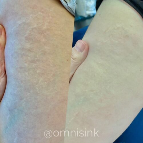 Stretch Mark Treatments Vancouver DAELA Shonna