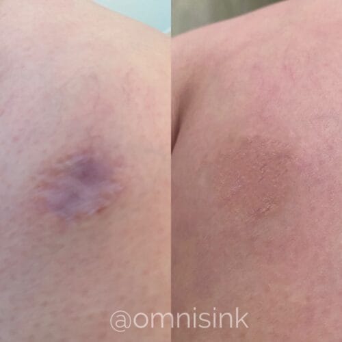 Scar camouflage tattoo by Shonna at DAELA Cosmetic Tattoo