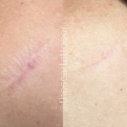 Scar Camouflage Tattoo DAELA Cosmetic Tattoo Portland-Shonna