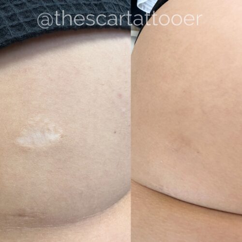 Scar Camouflage Tattoo Vancouver DAELA Shonna