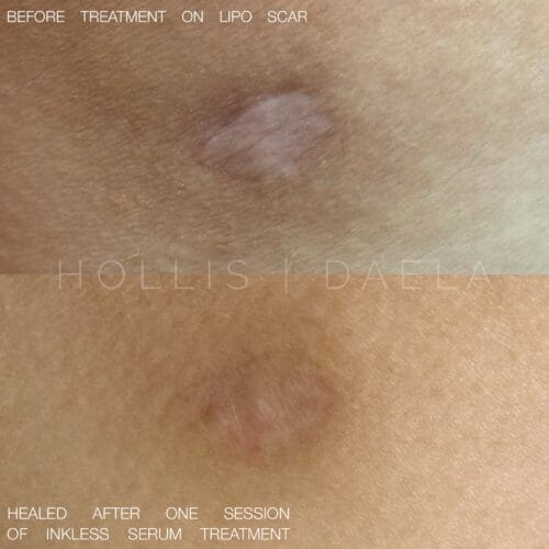 Inkless Scar Camoflage Treatments at DAELA Scottsdale