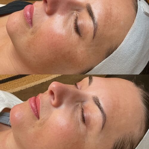 Laser facials in Scottsdale at DAELA