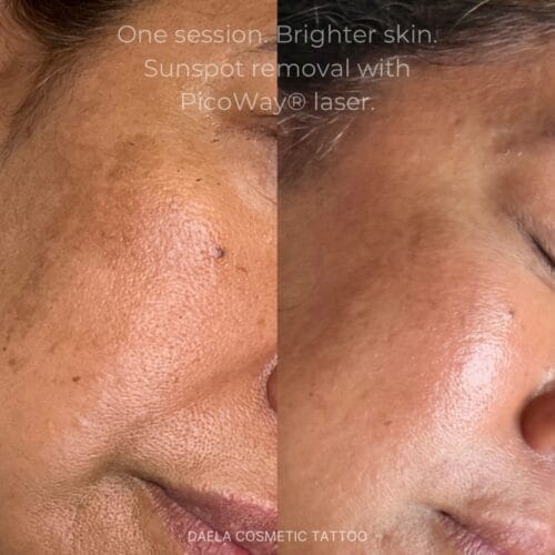 Laser facials in Scottsdale at DAELA