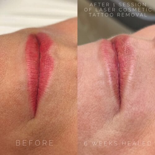 Laser PMU Removal DAELA Cosmetic Tattoo