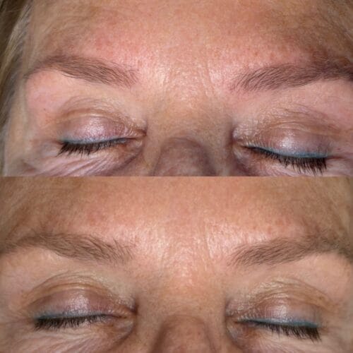 Laser Brow Tattoo Removal in Scottsdale