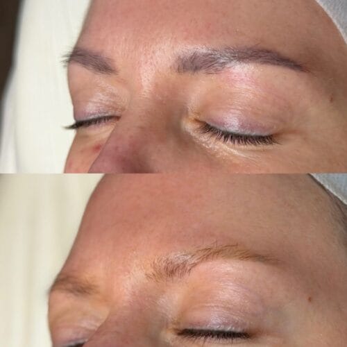 Laser Brow Tattoo Removal at DAELA Portland