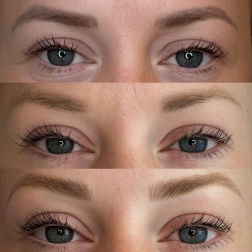 Laser PMU Removal Scottsdale at DAELA