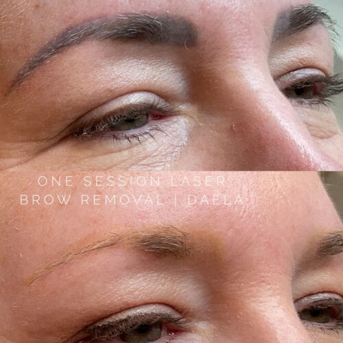 Laser Brow Tattoo Removal at DAELA Portland