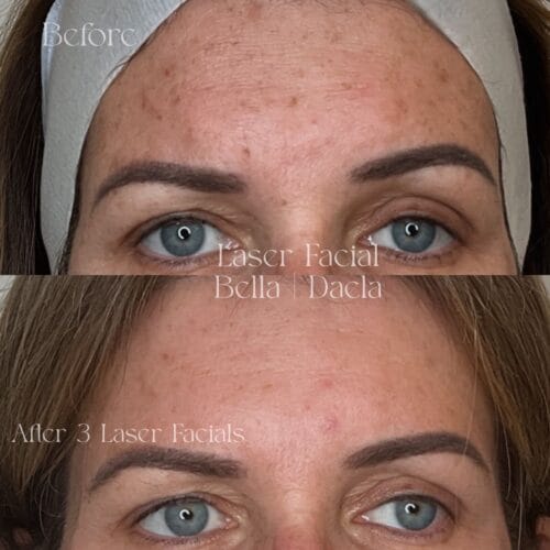 Laser Facials in Scottsdale at DAELA