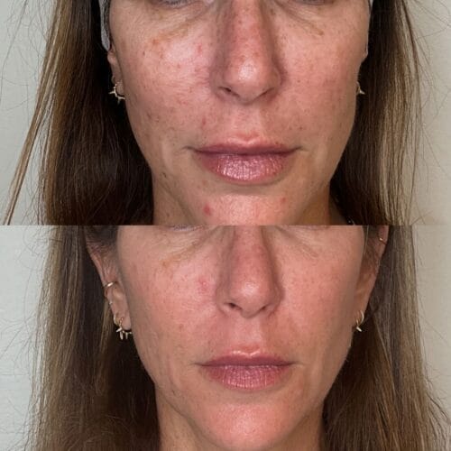 Laser facials in Scottsdale at DAELA