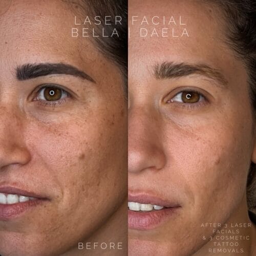 Laser Facials in Scottsdale at DAELA