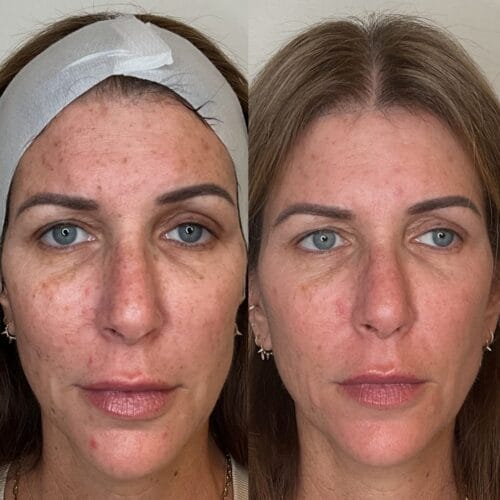 Laser facials in Scottsdale at DAELA