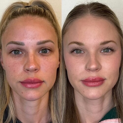 Laser Facials in Scottsdale at DAELA