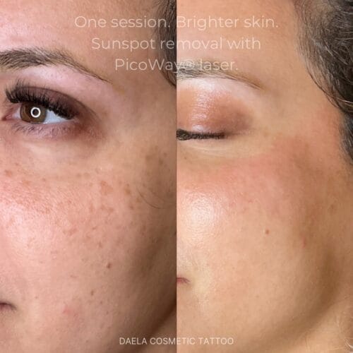 Laser Facials at DAELA Portland