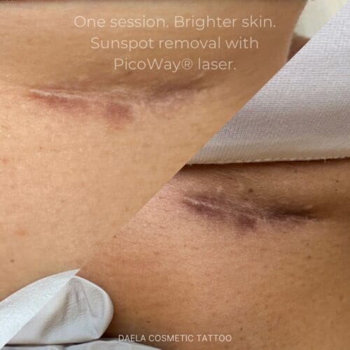 Laser facials in Scottsdale at DAELA