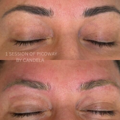 Laser Brow Tattoo Removal at DAELA Portland