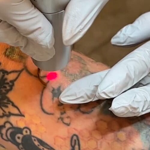 Laser tattoo removal in Scottsdale