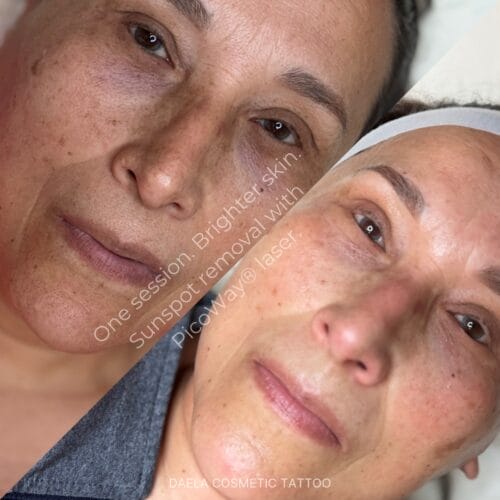 Laser Facials at DAELA Portland