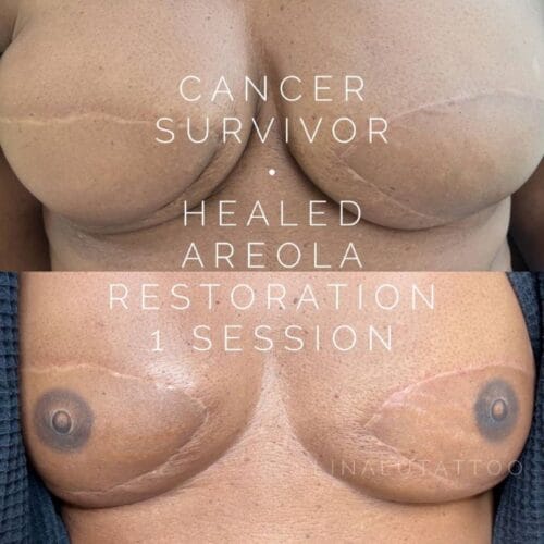 Areola Restoration in Portland at DAELA by Lina