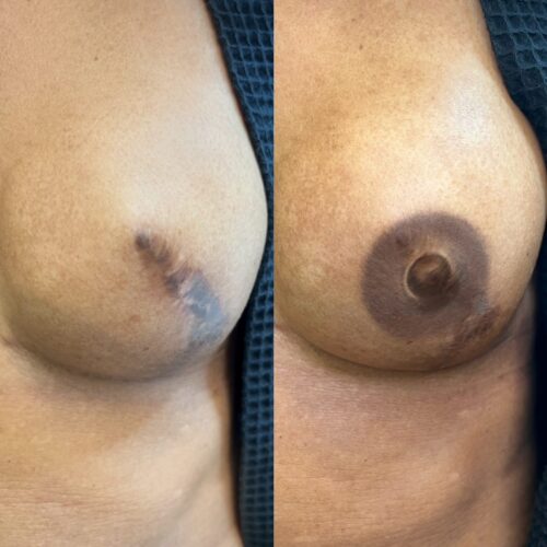 Areola Restoration Tattoo Vancouver DAELA Lina