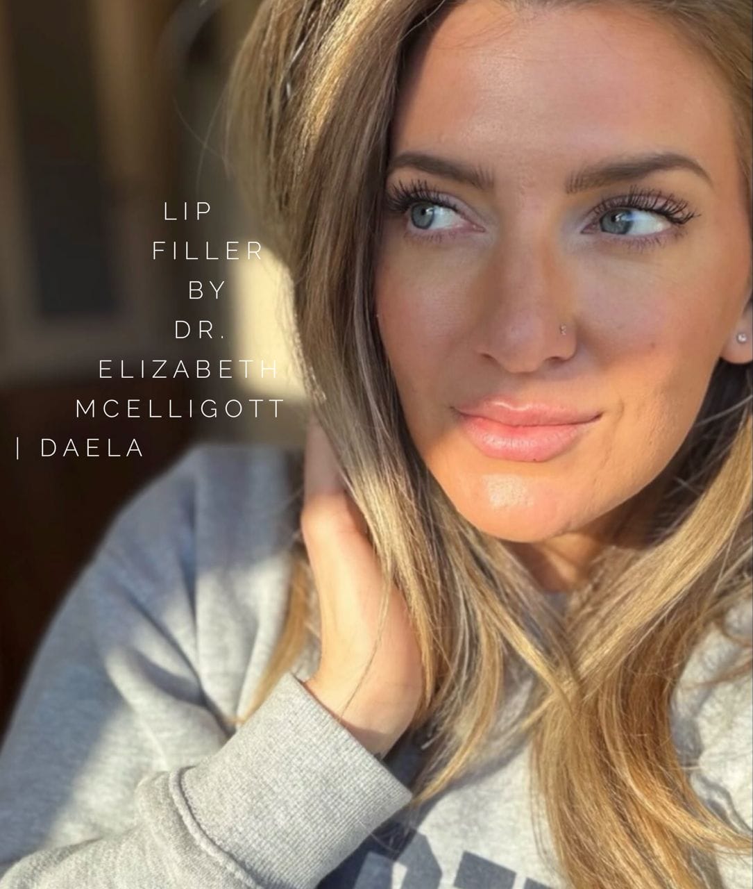 Whats trending for fillers in 2026