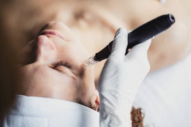 Microneedling in Portland at DAELA