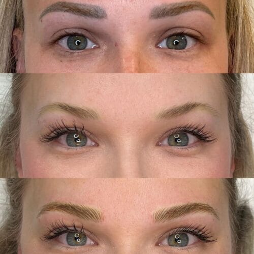 Permanent Makeup Removal in Scottsdale