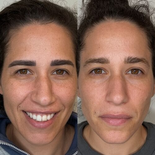 Laser Skin Treatment at DAELA Portland by Bella