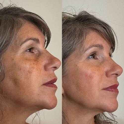 Laser Skin Treatment at DAELA Portland by Bella