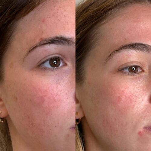 Laser Skin Treatment at DAELA Portland by Bella