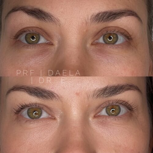 PRF for Undereye at DAELA Portland by Dr. Elizabeth McElligott