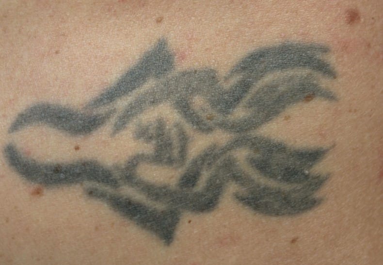 laser tattoo removal in Portland Oregon